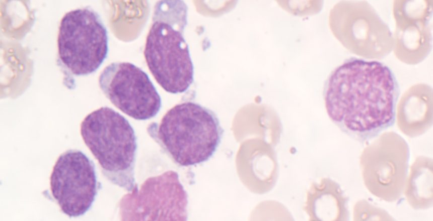 Mantle Cell Lymphoma- Leukemia
