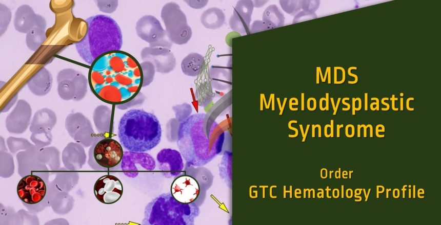 Myelodysplastic Syndrome (MDS)